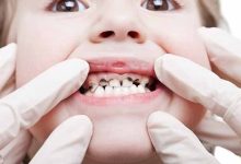 5 نصائح للوقاية من تسوس الأسنان
