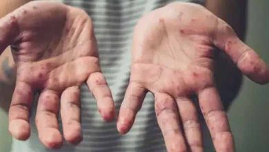 بسبب انتشار جدري القرود... تخوُّف وعنصرية في قطر ضد المثليين