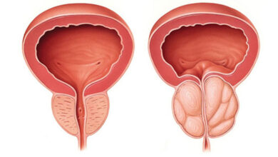 أسباب وعلاج تضخم البروستاتا
