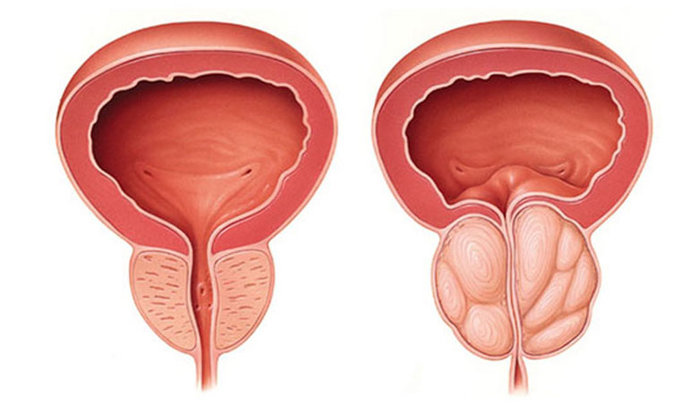 أسباب وعلاج تضخم البروستاتا