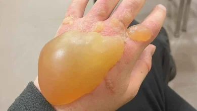 لا تلمسوها!.. نبتة تسبب حروقًا جلدية وتشكل خطرًا على الأطفال
