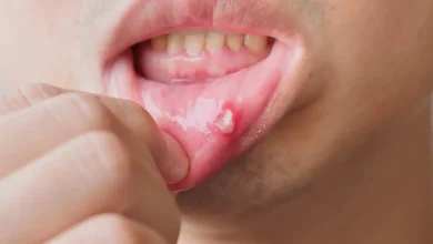 متى تتحول قرح الفم إلى جرس إنذار على مرض خطير؟