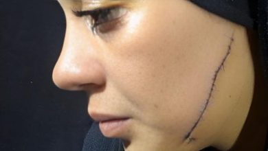 41 غرزة على جسد العروس.. مطلقة تنتقم من طليقها بطريقة دامية