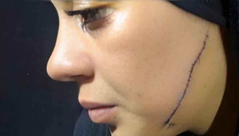 41 غرزة على جسد العروس.. مطلقة تنتقم من طليقها بطريقة دامية