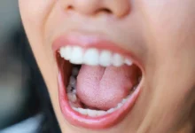 تصلب الشرايين والنوبات القلبية قد تبدأ من الفم