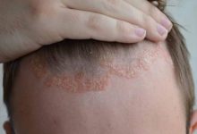 دراسة: تعديل الاستجابة المناعية للجلد قد يمنع انتكاس الصدفية
