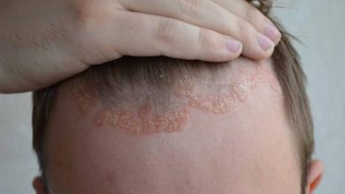 دراسة: تعديل الاستجابة المناعية للجلد قد يمنع انتكاس الصدفية