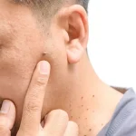 الزوائد الجلدية.. إشارة تحذيرية مبكرة لمقاومة الأنسولين