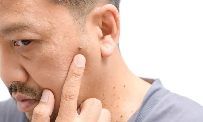 الزوائد الجلدية.. إشارة تحذيرية مبكرة لمقاومة الأنسولين