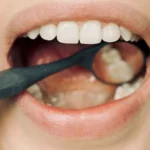 ما العلاقة بين صحة الفم والتهاب مفاصل اليد؟ دراسة تجيب